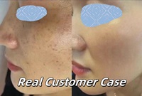 Crème pour le visage à base de bactéries lactiques anti-mélasma et anti-taches, enrichie en vitamines C et E, éliminateur de pigmentation et de taches noires, peeling chimique