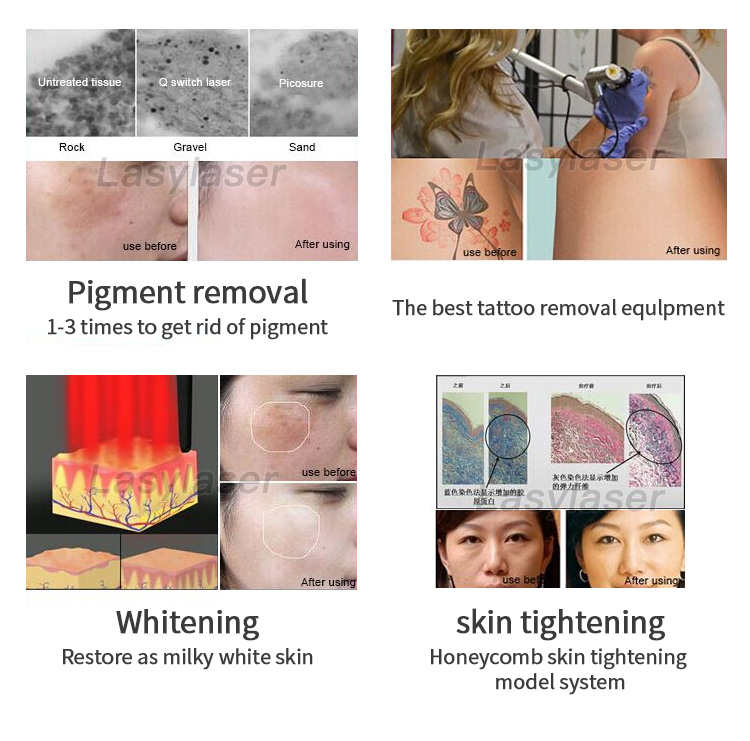 Nd:YAG picosecond laser instrument equipment to remove wrinkles and scars to lighten pores and improve acne