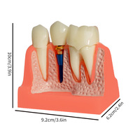 Modèle anatomique dentaire 4x pour la démonstration des implants, la restauration de prothèses, la ponte dentaire détachable, la couronne et l'utilisation pédagogique