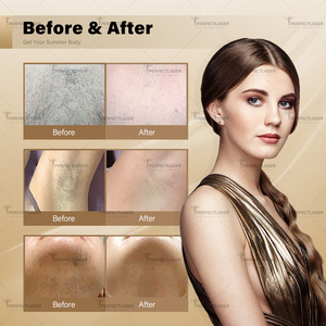 Salon Spa Thương Mại 755nm 1064nm Kép Bước Sóng Alexandrite Máy <span class=keywords><strong>Laser</strong></span> Nhẹ Nhàng Dài Xung Nd Yag <span class=keywords><strong>Laser</strong></span> Tóc Loại Bỏ Thiết Bị - Product Image 6