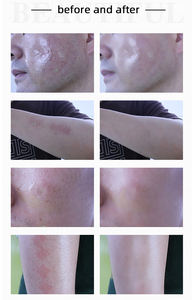 Appareil CE approuvé OEM Thulium 1927nm pour l'élimination des cicatrices et des rides, le blanchiment, le resserrement vaginal, et le nettoyage facial fractionnel non ablatif au Thulium - Product Image 6