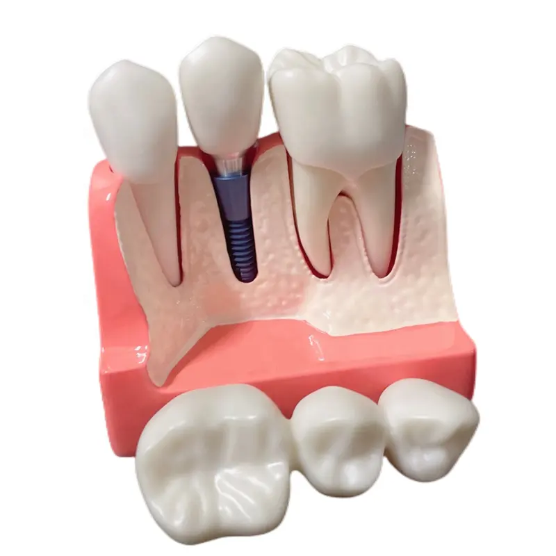 Zahn zähne Modell 4-fache Implantat lösung Modell Prothesen restauration Zahnimplantat-Erklärung Abnehmbare Brücken krone