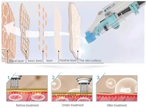 Nouvelle machine de beauté anti-âge pour le <span class=keywords><strong>visage</strong></span>, à <span class=keywords><strong>injection</strong></span> de mésothérapie, pour le nettoyage des rides et le soin de la peau, à usage ciblé. - Product Image 4