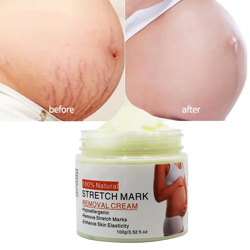 Stretch Mark Treatment Postpartum Stretch Mark