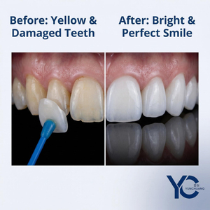 Carillas Dentales de Cerámica, Alta Dureza, Resistentes a la Corrosión, Resaltando el Encanto de tu Sonrisa - Product Image 2