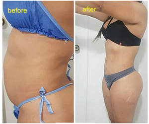 Оборудование для липолиза, 980 нм, 1470 нм - Product Image 6