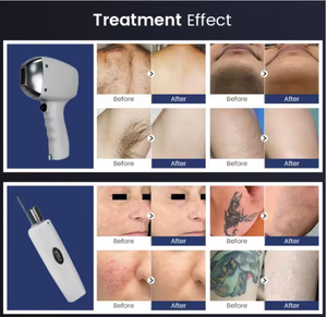 เครื่องมือคุณภาพสูง 3-in-1 กำจัดขนได้อย่างรวดเร็วและไม่เจ็บปวด สำหรับขนทุกสีทั่วร่างกาย - Product Image 5