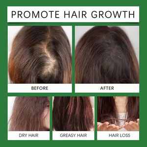 Natural Organic Private Label Treatment Fast <strong>Hair</strong> Care Biotin Rosemary <strong>Hair</strong> Growth Oil <strong>Spray</strong> - Product Image 5