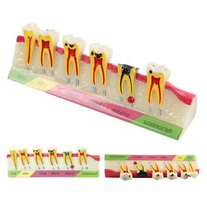 Dental <b>Teeth</b> Model 6-Stage Caries Development Educational Model for Periodontal Disease Patient Display - Product Image 3