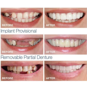चौथी पीढ़ी के सिलिकॉन झूठे दांत दांत सही मुस्कान वेनर आराम फिट फ्लेक्स डेन्चर ब्रेसिज आराम फिट फ्लेक्स डेन्चर ब्रेस पहनने के लिए आरामदायक - Product Image 4