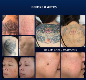 เครื่องเลเซอร์กำจัดรอย<span class=keywords><strong>สัก</strong></span> เครื่องเลเซอร์กำจัดรอย<span class=keywords><strong>สัก</strong></span>และรอยแตกลาย Nd Yag เครื่องเลเซอร์กำจัดรอย<span class=keywords><strong>สัก</strong></span>แบบพิโคเซคันด์ - Product Image 4