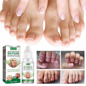 EELHOEWholesale 20ml Traitement et Réparation <span class=keywords><strong>des</strong></span> Mycoses <span class=keywords><strong>des</strong></span> <span class=keywords><strong>Ongles</strong></span> <span class=keywords><strong>des</strong></span> Pieds, Soin Anti-Fongique, Élimination <span class=keywords><strong>des</strong></span> Mycoses, Outils et Fournitures pour <span class=keywords><strong>Ongles</strong></span> Pedivac - Product Image 5