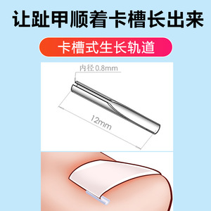 Dispositivo de corrección de uñas encarnadas para niños con parche de aislamiento - Product Image 5