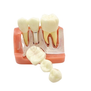 Dentaire Bon Prix Dentaire Enseigner Dent Modèle Caries Dentaires Développement Modèle - Product Image 1