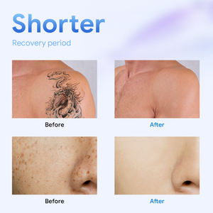 Picoseconde 1064 nm 532nm <span class=keywords><strong>Pico</strong></span> Q commuté Nd Yag <span class=keywords><strong>Laser</strong></span> <span class=keywords><strong>Pico</strong></span> <span class=keywords><strong>Laser</strong></span> détatouage Prix de la machine élimination de la pigmentation - Product Image 6