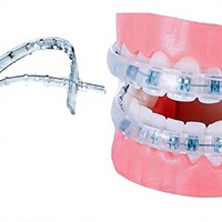 Protège-lèvres orthodontique confortable en plastique pour appareils dentaires, protège-dents, bouclier dentaire, alternative à la cire dentaire