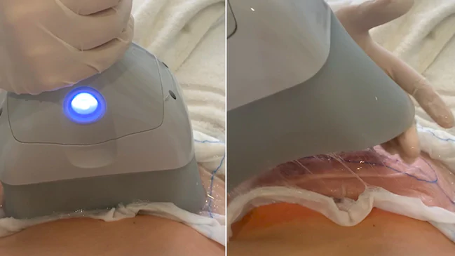 Home use professional cryo lipo cryotherapy machine fat reduction for body sculpting slimming machine