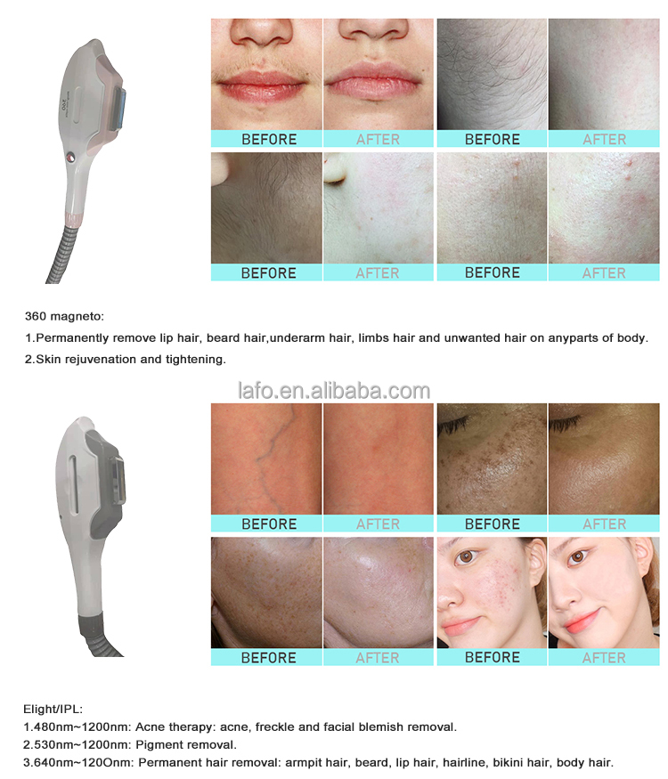 LAFO 4 In 1 OPT + IPL+ Rf+ Nd YAG Permanent hair removal laser Tattoo Removal Skin Rejuvenation beauty machine 4 handles