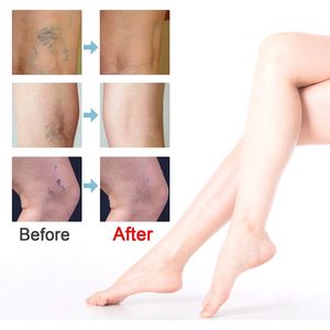 Crème pour les varices South Moon, phlébite, varices, inflammation des veines, crème pour les jambes - Product Image 5