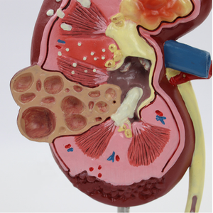 Modelo Anatómico de Riñón con Quiste Renal, Modelo de Anatomía Humana para Enseñanza Médica, Equipo de Patología Renal para Modelo de Quiste Renal - Product Image 3