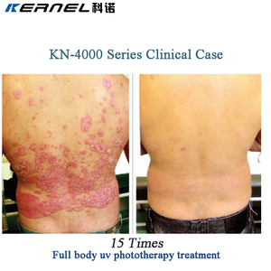 Thérapie par lumière UVB à bande étroite 311 nm *40 pièces, cabine de photothérapie UV pour le corps entier, traitement du vitiligo et du psoriasis - Product Image 5