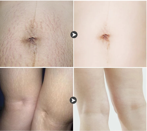 Cicatrice Vergetures Crème Dépilatoire avec Forte Blanchissant et Effet Réparateur - Product Image 4