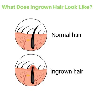 Crema de tratamiento del cabello encarnado, después del afeitado eliminador de quemaduras, <span class=keywords><strong>Gel</strong></span> calmante, Etiqueta Privada - Product Image 5