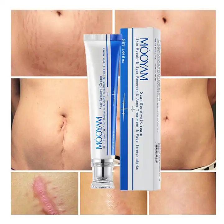 Fastest Acne Scar Removal Cream Face Care Scar Gel Bruise Repair Cream Tummy Tuck Tightening 30g Stretch Mark Scar Removal Cream