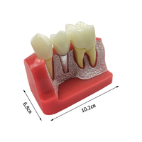 Modèle anatomique dentaire 4 fois plus grand pour implants, couronnes et bridges, en résine, pour l'analyse, la démonstration et la formation en dentisterie amovible