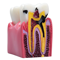 Modelo Educativo de Anatomía de Caries Dentales, Plástico, 6 Secciones Transversales, Demostraciones de Comparación Bilateral, Estudio de Ciencias Médicas