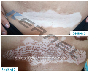 Sistem radiasi <span class=keywords><strong>UV</strong></span> Kernel tinggi 308nm, Excimer UVB peralatan fototerapi Vitiligo tangan Psoriasis peralatan terapi fisik - Product Image 2