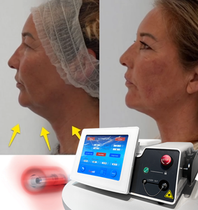 Equipo Láser Endo Laserlift 980nm 1470nm <span class=keywords><strong>para</strong></span> Endolifting, Precio de Máquina de Liposucción Láser 980nm, Dispositivo Médico - Product Image 2