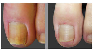 Lange Puls Ndyag Fiber Laser 1064nm Medische Kwaliteit Voor Professionele Haarverwijdering & Vasculaire Laesie Behandeling Op Donkere Huid - Product Image 4