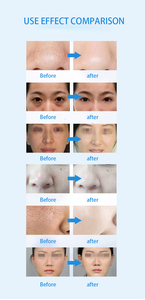 Nueva Máquina de Belleza Inteligente 7 en 1 con Hidrodermoabrasión, Oxígeno y Punta de Diamante, Color Azul Hielo, para Limpieza y Rejuvenecimiento de la Piel - Product Image 5