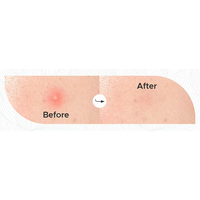 Patch anti-acné hydrocolloïde personnalisé en forme de cœur, patch transparent miracle pour couvrir les boutons et les imperfections
