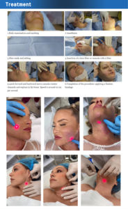 <span class=keywords><strong>Prix</strong></span> Usine Endopulse 635nm 980nm 1470nm Endo Fiber Liposuction 980 Y 1470 Haute Gamme - Product Image 3