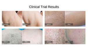 Aparato de Depilación Láser de Diodo de Alta Capacidad con Pantalla Táctil 4K - Product Image 6