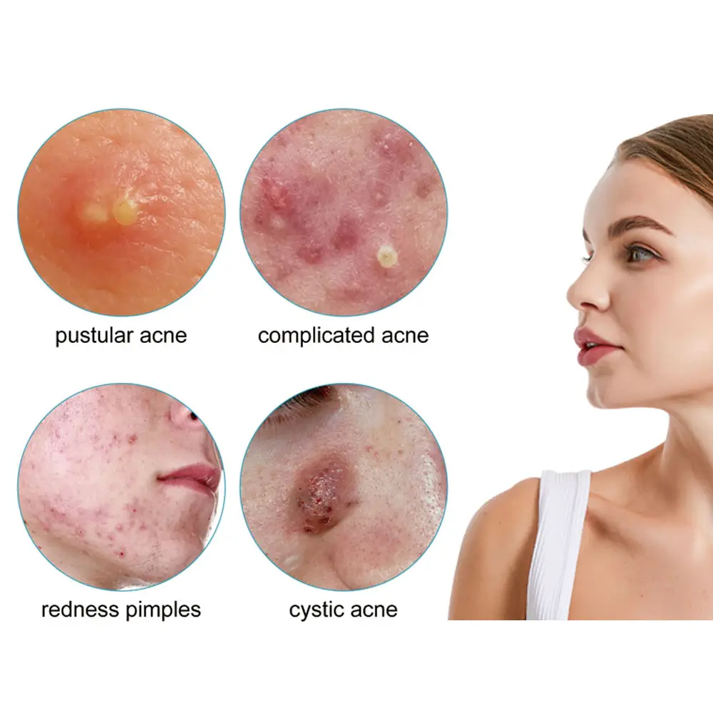Remendos 100% hidráulicos de cura para acne e espinhas, patches hidráulicos de micro-colisão, cobrindo a pele e cuidados com a cara