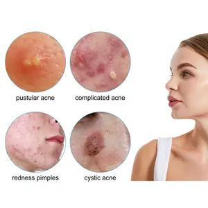 100% Hydrocolloid Microdart Pimple Acne Spot Healing Patches Oem para cubrir el cuidado de la piel de la cara