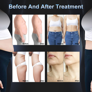 Mới Nhất Vẻ Đẹp Khuôn Mặt Nâng Cellulite Loại Bỏ 8 Xử Lý Chất Béo Mỏng Cavit 80K Chân Không Rfslim <span class=keywords><strong>S</strong></span> Cơ Thể Hình Giảm Béo Giá Máy - Product Image 6
