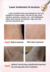 Máquina Láser de Diodo Avanzada de 980nm 5 en 1 para Tratamiento de Lesiones Vasculares Corporales y Hongos en las Uñas con Material ABS - Product Image 5