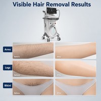 Équipement de beauté pour salon, machine d'épilation au laser super rapide haute puissance 3000W 755nm 808nm 940nm 1064nm