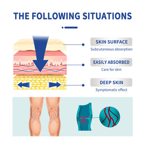 <span class=keywords><strong>Precio</strong></span> de fábrica South Moon Crema para venas varicosas 20g Flebitis Araña Alivio del dolor Crema para <span class=keywords><strong>eliminar</strong></span> la angiitis - Product Image 5