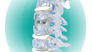 Rangka Fusi <span class=keywords><strong>Interbody</strong></span> Serviks, Berbentuk Wedge & Bentuk Busur - Product Image 4