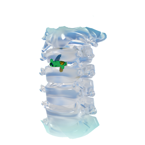 Orthopedische Chirurgische Implantaten <span class=keywords><strong>Titanium</strong></span> Fedex Aangepast Nulprofiel Anterieure Cervicale Kooi Instrumenten Klasse Iii Ce Gecertificeerd - Product Image 1