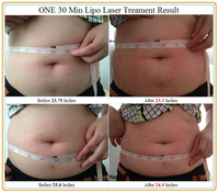 Appareil de lipolyse laser 6D avec canules lipolytiques pour la dissolvation des graisses, traitement injectable du double menton, thérapie par lumière rouge Invisa