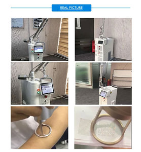Carbon Dioxide CO2 Laser scanxel Vòng tay bộ phận máy 60 Wát 2024 bác sĩ da liễu Mini Bison y tế fractional - Product Image 3