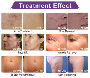 Appareil portable de microneedling RF, stylo de traitement de <span class=keywords><strong>radiofréquence</strong></span> <span class=keywords><strong>fractionnée</strong></span> pour le rajeunissement cutané, machine à aiguilles dorées RF - Product Image 5