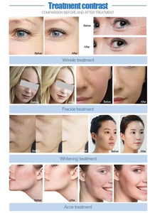 Appareil de soin du visage à jet d'eau oxygénée, <span class=keywords><strong>Aqua</strong></span> Peel non invasif, nettoyage en profondeur de la peau, équipement de beauté pour salon, pour le rajeunissement du visage - Product Image 3