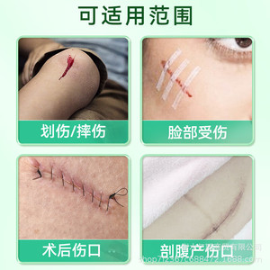 เทปปิดแผลทางการแพทย์แบบไม่ระคายเคือง ระบายอากาศได้ ขนาด 6x100 มม. สำหรับใช้ในงานผ่าตัด - Product Image 2